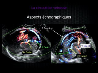 Les Centres de référence Maladies Rares : pathologies neurovasculaires malformatives
