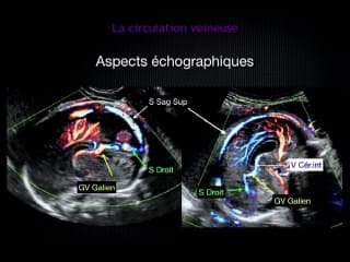 Les Centres de référence Maladies Rares : pathologies neurovasculaires malformatives
