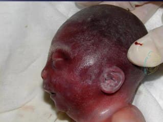 SLO (Smith Lemli Opitz)