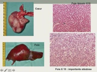 Un syndrome de Wiedemann Beckwith.