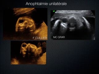 Echographie foetale : que peut-on voir ? Que faut-il voir ?