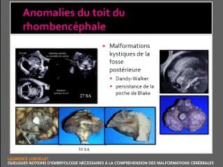Quelques notions d'embryologie nécessaires à la compréhension des  malformations cérébrales