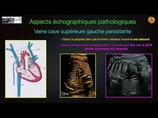 CŒUR ET VAISSEAUX Sinus coronaire : un GPS cardiaque