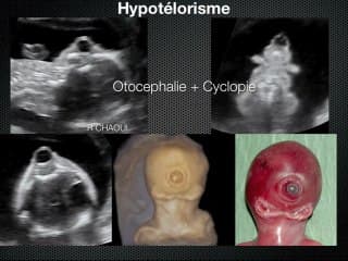 L'oeil foetal : une simple observation pour un diagnostic complexe Etude de cas sélectionnés et colligés par le CFEF.