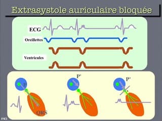 Troubles du rythme cardiaque Comment caractériser les troubles du rythme cardiaque (2D, doppler, TM)