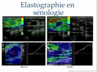 Et l’élastographie dans tout cela ?
