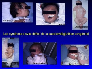 Pharynx : analyse fonctionnelle et déglutition