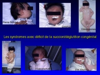 Pharynx : analyse fonctionnelle et déglutition