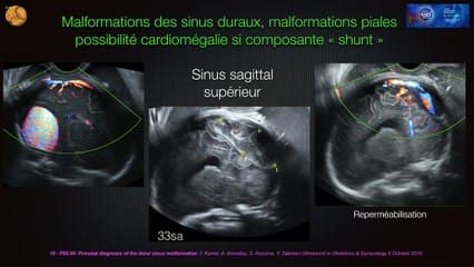 Coeur foetal II : c’est trop gros ! Fistules artério-veineuses et tumeurs vasculaires
