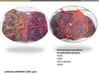 Grossesses gémellaires, pièges et difficultés de diagnostic et de surveillance