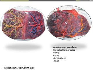 Grossesses gémellaires, pièges et difficultés de diagnostic et de surveillance