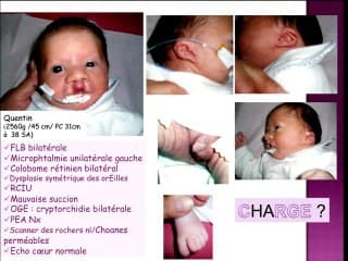 Anomalie foetale révélatrice d'une pathologie familiale : signe d'appel cranio cerebral