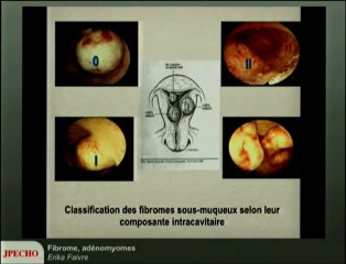 Fibrome, adénomyomes