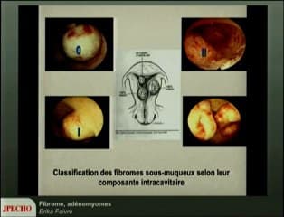 Fibrome, adénomyomes