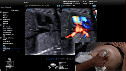 live coeur foetal