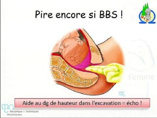Echographie en salle de naissance en pratique