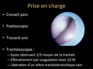 Prise en charge in utero d'une obstruction trachéale foetale