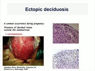 Grossesse et endométriose