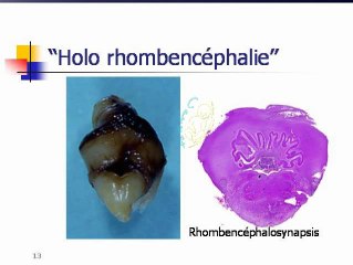 Les holoprosencéphalies