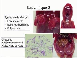 A+B = … ? Dix syndromes à évoquer dès l’association de seulement 2 signes échographiques.