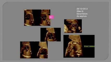 pathologie du cœur: rétrécissement aortique