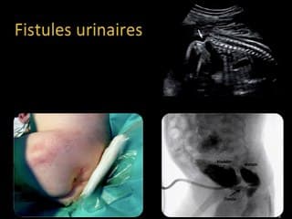 Considérations techniques de l'ablation laser des valves de l'urètre postérieur par cystoscopie foetale