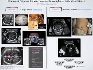 POSTER Ventricules-Complexe cérébral antérieur