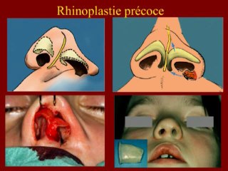 Fente labio-palatine Chirurgie secondaire