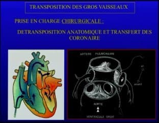 L’hémodynamique des coeurs pathologiques TGV transposition des gros vaisseaux