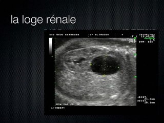 Mise au point sur le bilan échographique d’une image liquidienne inhabituelle intra- abdominale