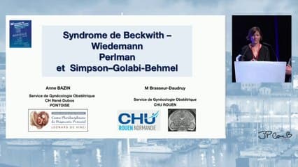 Les syndromes d’hypertrophie fœtale globale : BW, Perlman, Simpson Golabi B