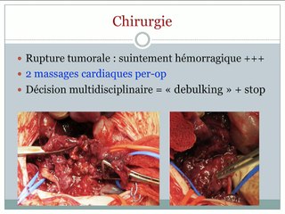 Une volumineuse tumeur abdominale à 32 SA.