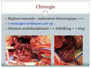 Une volumineuse tumeur abdominale à 32 SA.