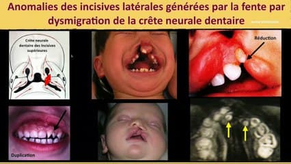 Imagerie des fentes labio-palatines et vélo-palatines