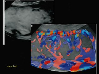 Placenta