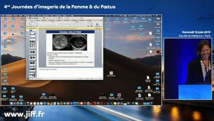 SYSTÈME NERVEUX CENTRAL Quiz : télengiectasie capillaire ; papillome plexus choroide ; rhombencephalosynapsis ; dysgenesie vermienne ; lissencephalie type 1