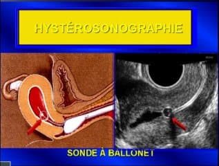 Echographie pelvienne dans l’AMP et dans le bilan de l’infertilité