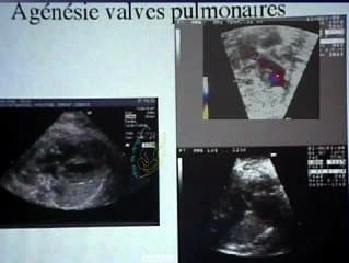 Malformations cardiaques rares : agénésie des valves pulmonaires/double discordance/tunnel ventriculo-aortique