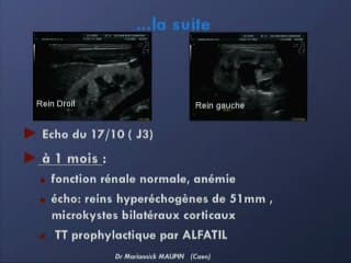 Reins hyperéchogènes