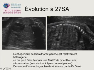 Une hernie diaphragmatique au 3eme Trimestre.