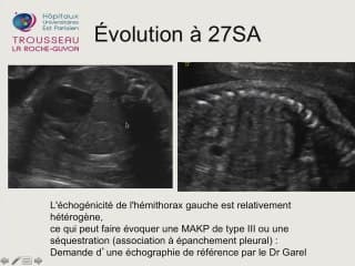 Une hernie diaphragmatique au 3eme Trimestre.