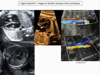 L’indispensable bilan d’imagerie thoraco-abdominal.