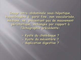Kyste du choledoque