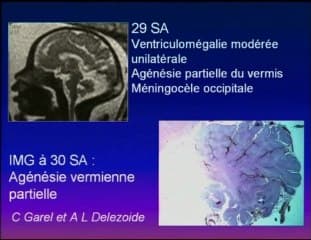 Le diagnostic anténatal d’un syndrome de Joubert est-il possible ?