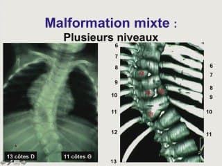 Rachis : anomalie de courbure, anomalies vertébrale et costale - traitement et pronostic.