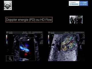 Réglages machines : les doppler Bien régler le doppler; Bien utiliser les index