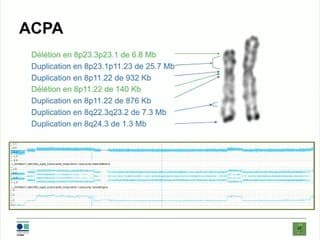 23 Quand le chromoanalysis s'invite en prénatal: à propos d'un cas