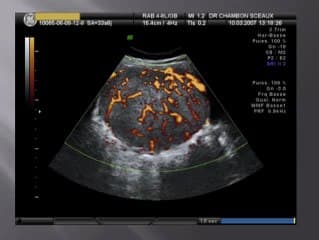 Adénome hépatique maternel