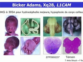 Cerveau? Découverte d?une anomalie cérébrale : que faut-il rechercher ? Quand demander une enque_te génétique ?
