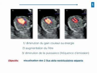 Etude flash Coeur 1er trimestre